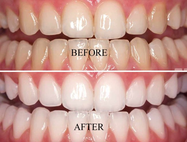 Professional Teeth Whitening in Lucknow